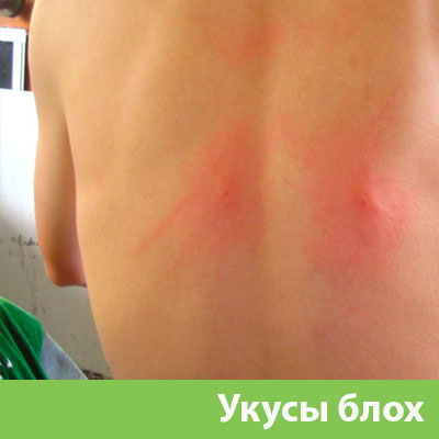 Укусы блох в Глазове