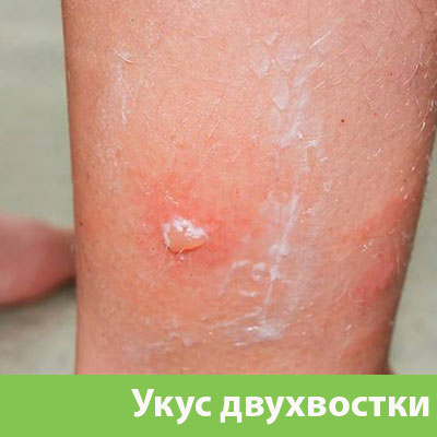 Укус двухвостки в Глазове
