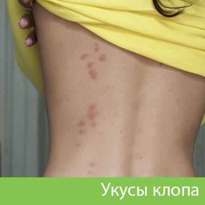 Профессиональное уничтожение клопов в Глазове